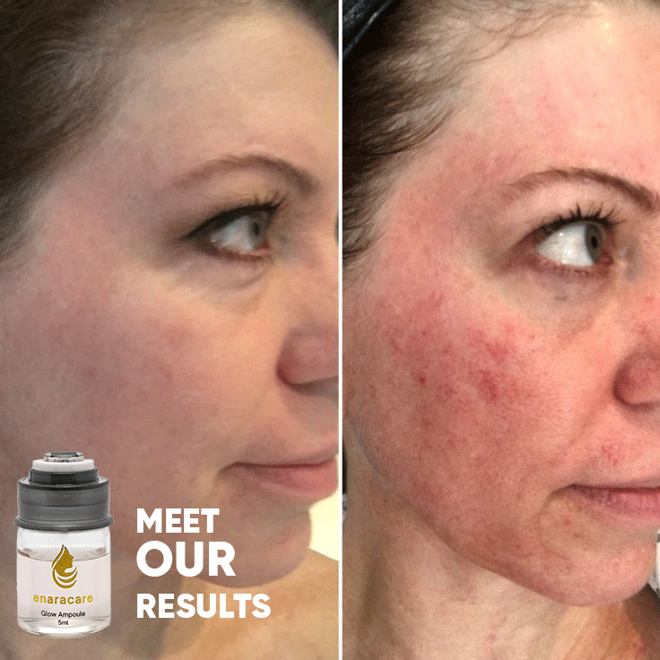 EnaraCare™ - Advanced Skin Rejuvenation Serum with PDRN & EGF